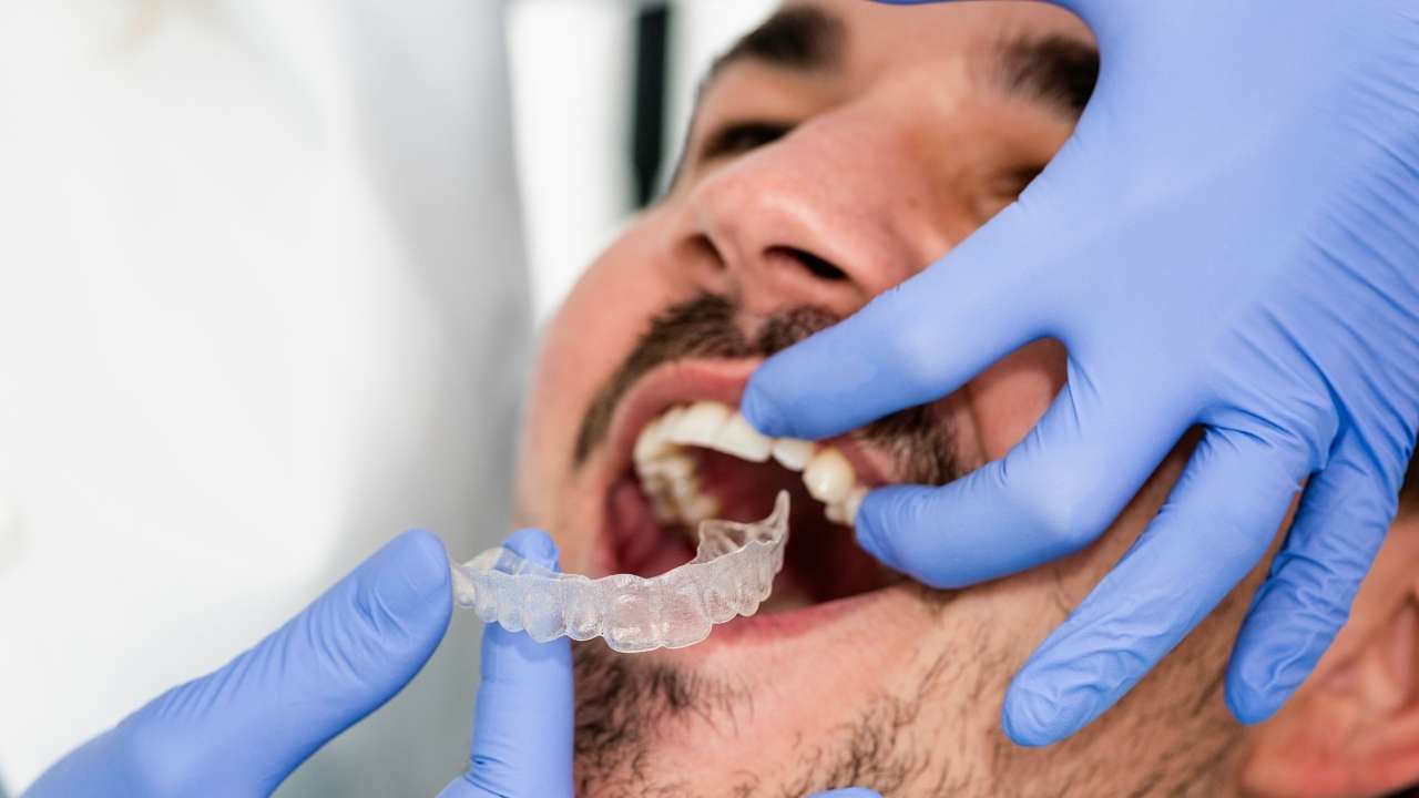 Como funciona o alinhador dental transparente? - Ortodontia Curitiba